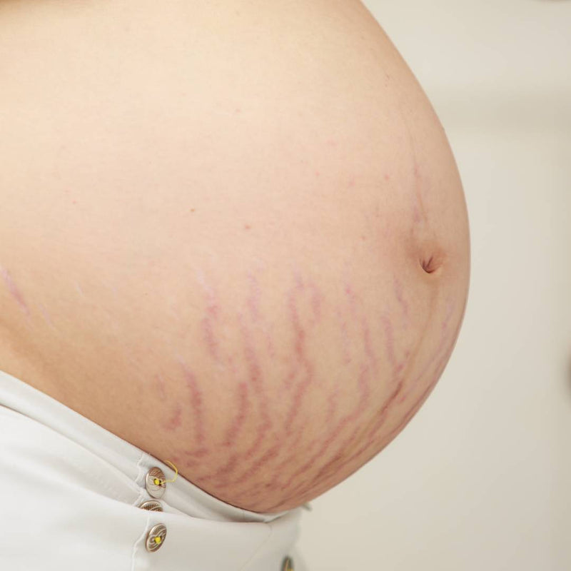 A pregnant belly with visible stretch marks